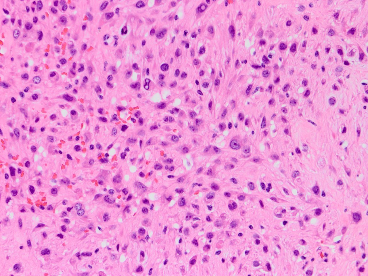 Epithelioid Schwannoma