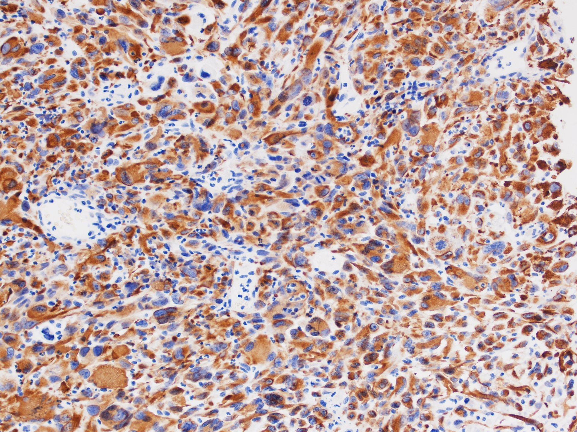 Pleomorphic Rhabdomyosarcoma Prs 多形型横紋筋肉腫 軟部腫瘍病理の部屋