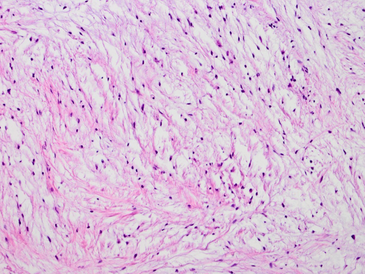 Juxtaarticular myxoma 傍関節性粘液腫 軟部腫瘍病理の部屋