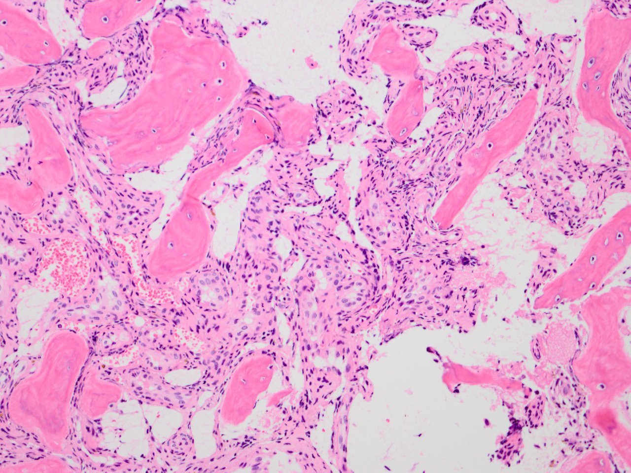 Epithelioid Hemangioma And Epithelioid Hemangioendothelioma 類上皮血管腫と類上皮血管内皮腫 軟部腫瘍病理の部屋