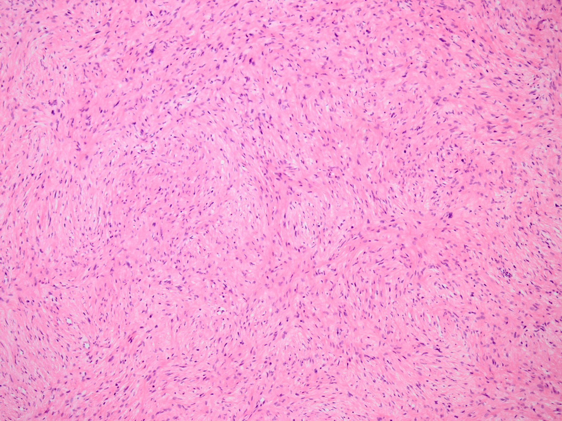 Hybrid Schwannoma And Perineurioma 融合型神経鞘腫 神経周膜腫 軟部腫瘍病理の部屋