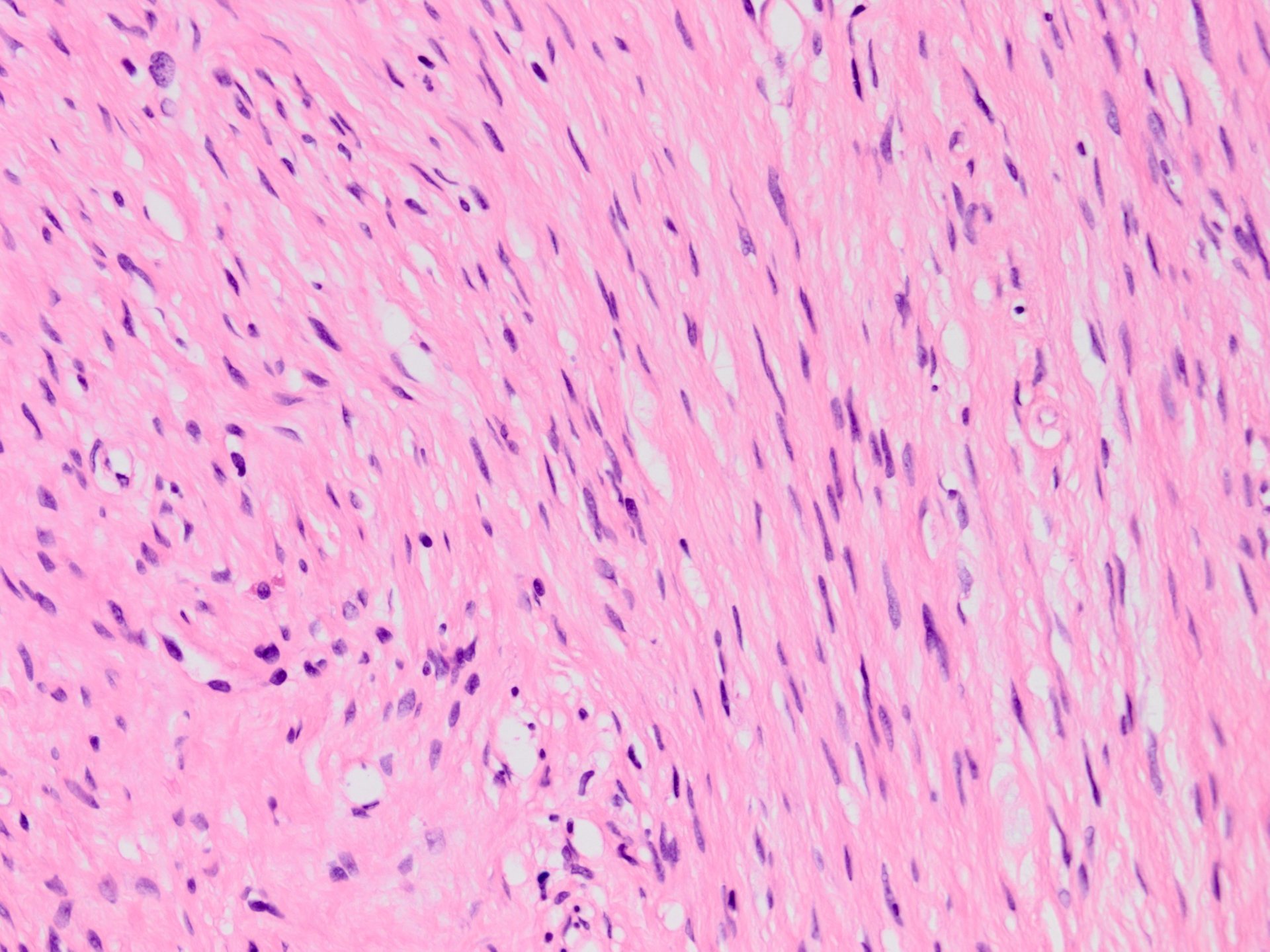 Hybrid Schwannoma And Perineurioma 融合型神経鞘腫 神経周膜腫 軟部腫瘍病理の部屋