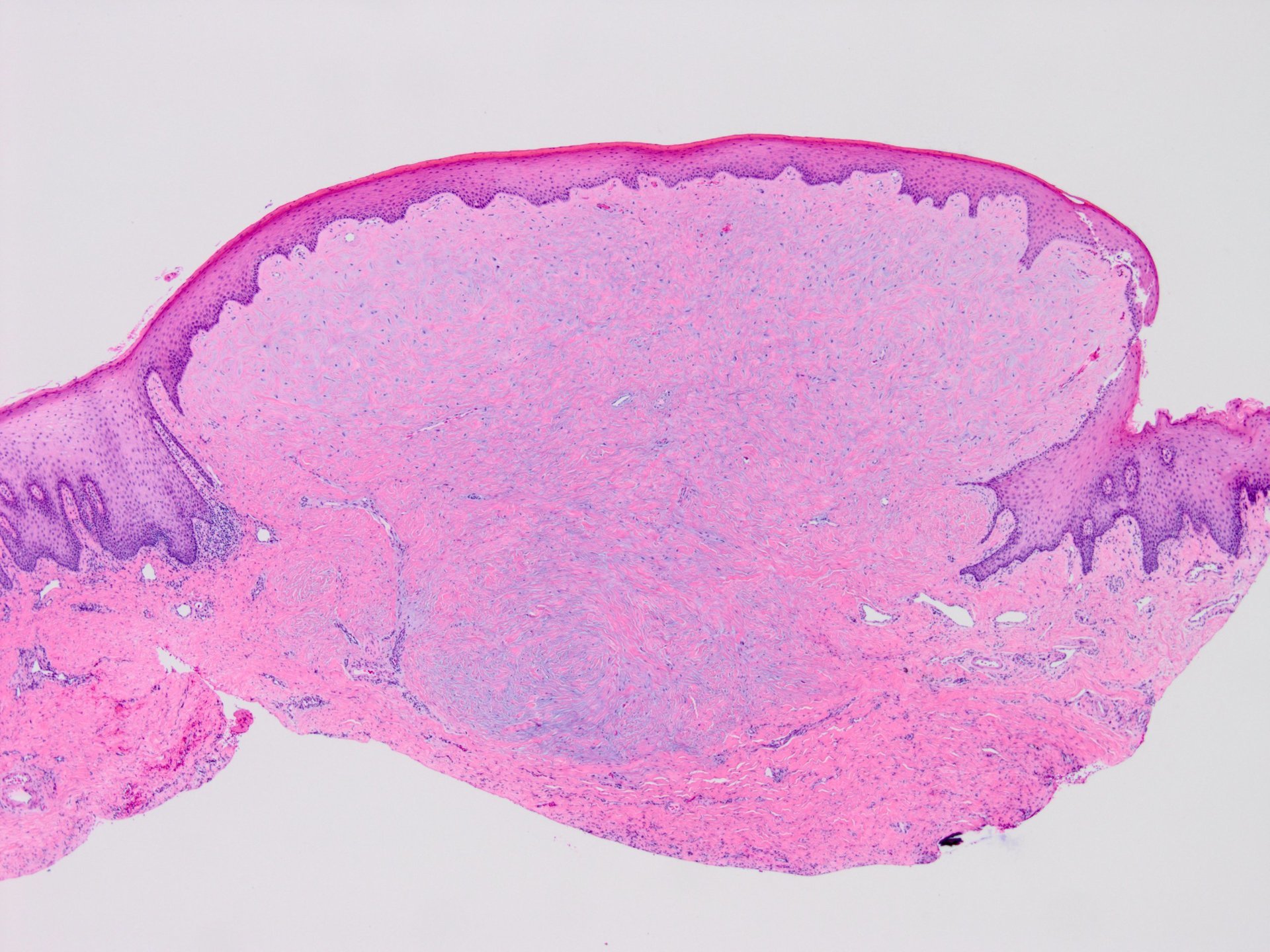 Desmoplastic fibroblastoma (collagenous fibroma) of the oral cavity 口腔の ...