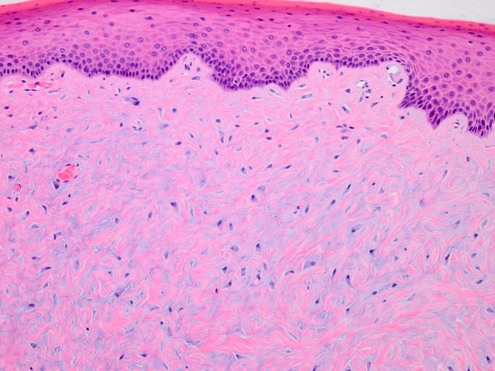 Desmoplastic fibroblastoma (collagenous fibroma) of the oral cavity 口腔の ...