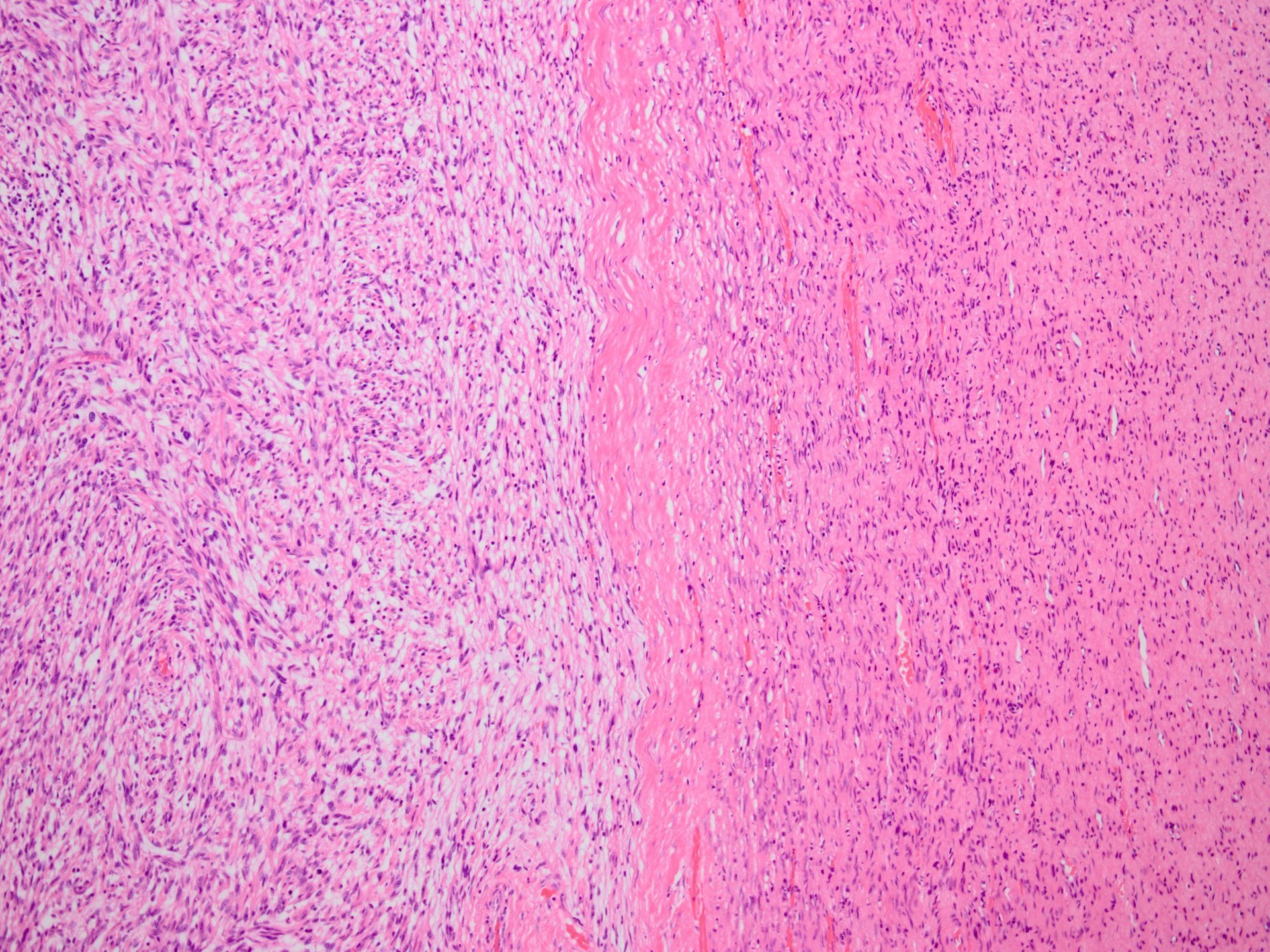 Low-grade malignant peripheral nerve sheath tumor (MPNST) 低悪性度悪性末梢神経鞘腫瘍:  軟部腫瘍病理の部屋