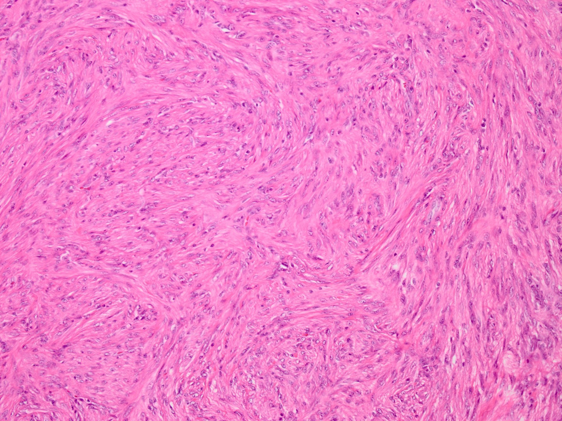 Atypical fibrous histiocytoma of the skin (atypical dermatofibroma 