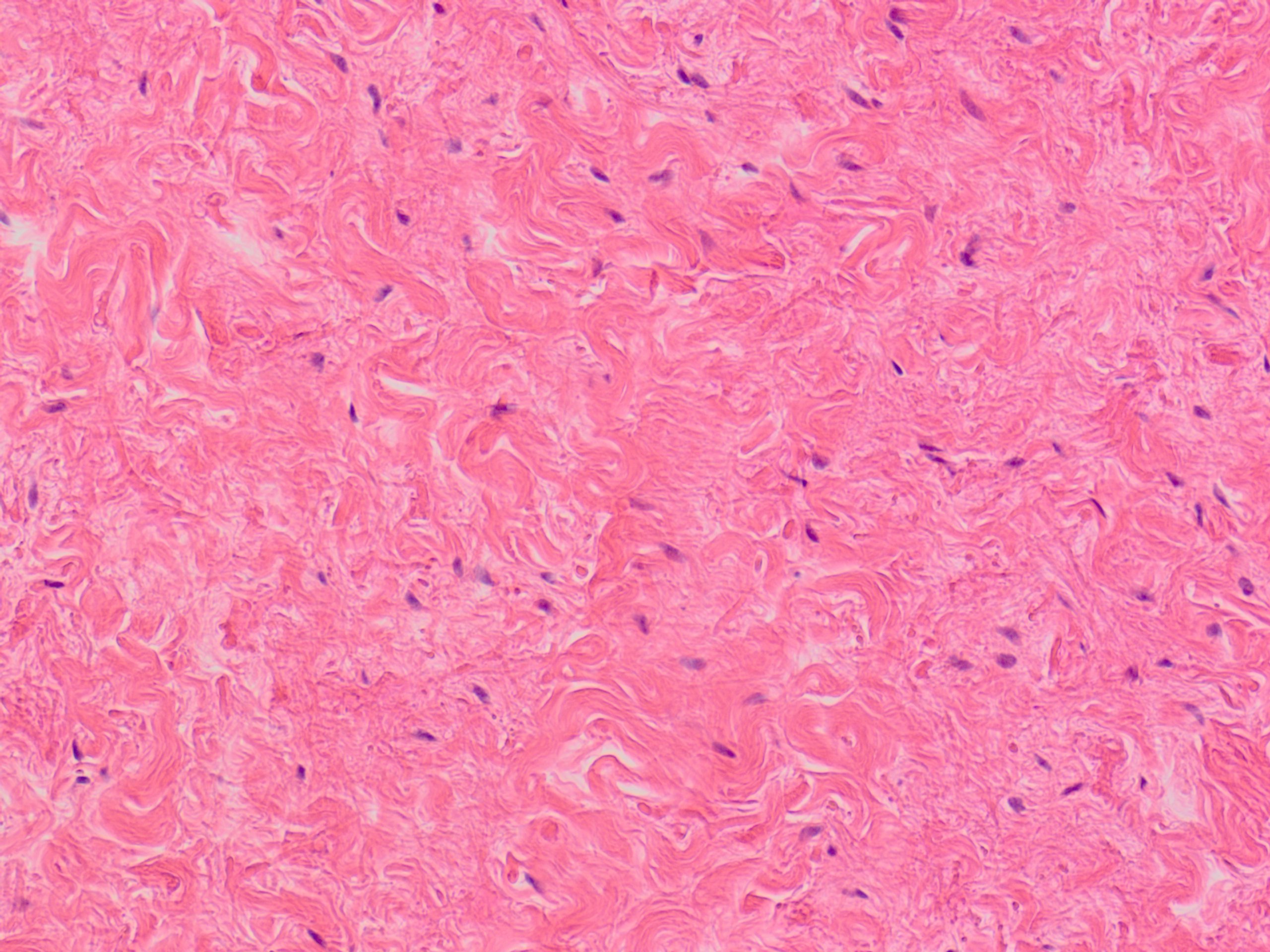 Desmoplastic Fibroblastoma Collagenous Fibroma 線維形成線維芽細胞腫 膠原性線維腫 軟部腫瘍病理の部屋