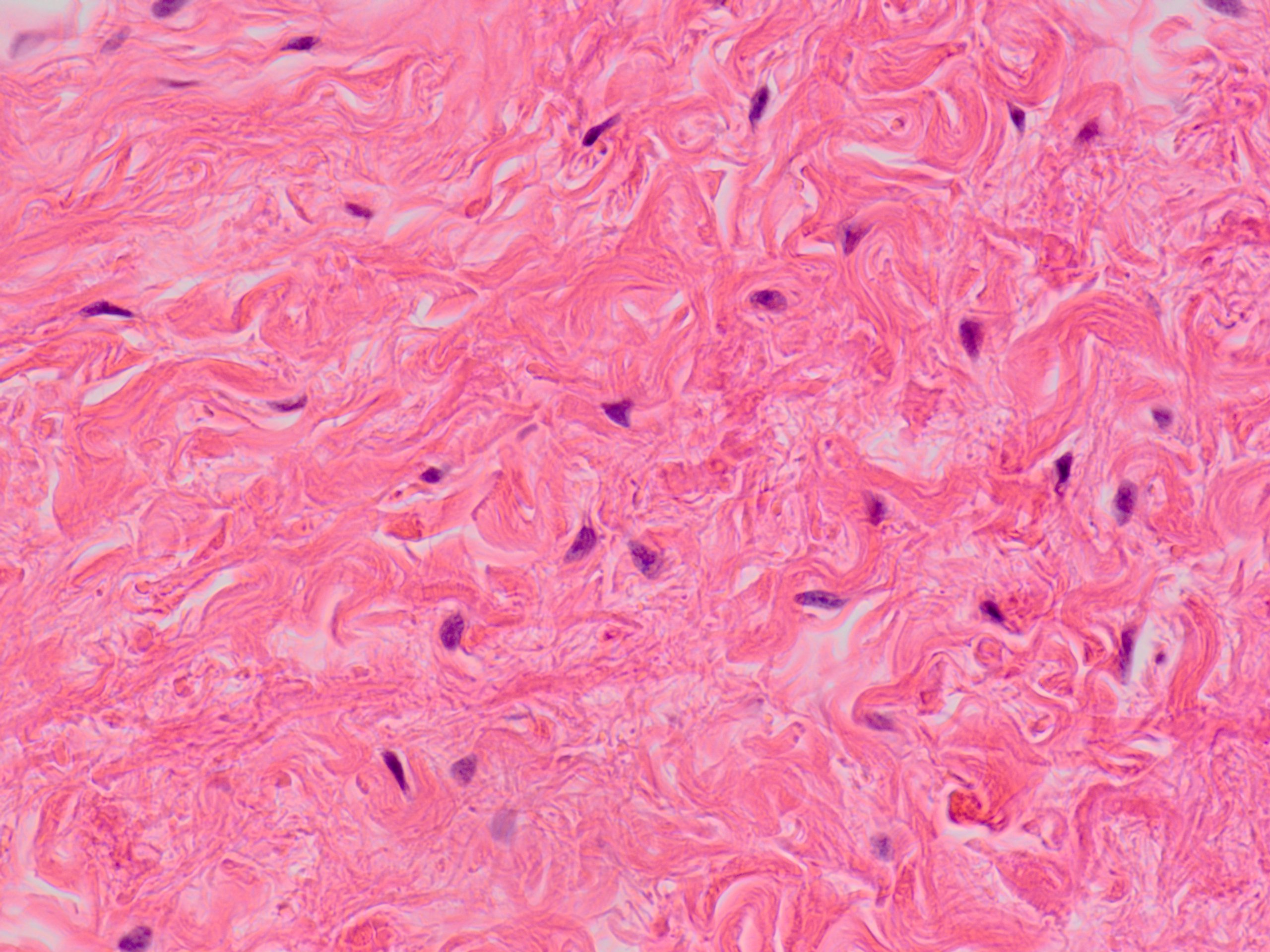 Desmoplastic Fibroblastoma Collagenous Fibroma 線維形成線維芽細胞腫 膠原性線維腫 軟部腫瘍病理の部屋