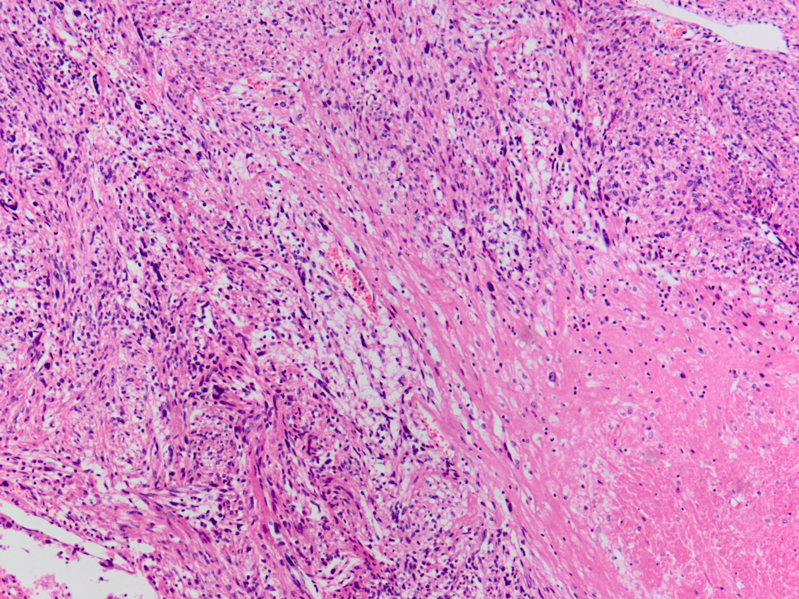 Uterine Leiomyosarcoma 子宮平滑筋肉腫 軟部腫瘍病理の部屋