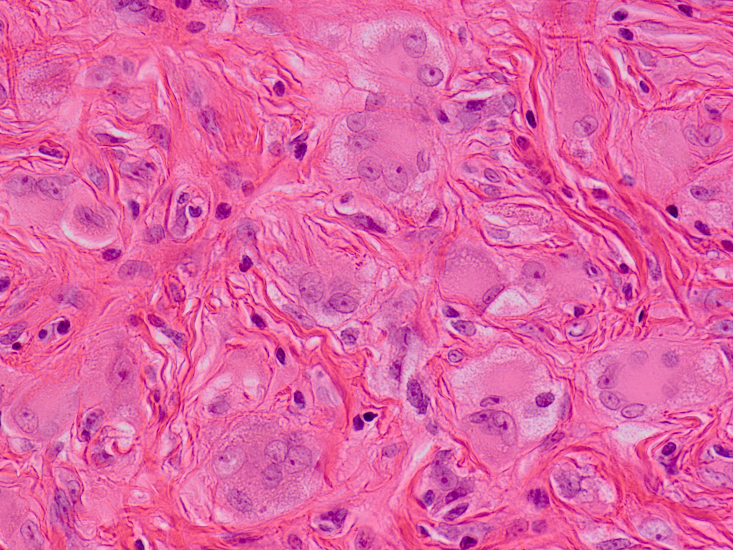 Solitary Reticulohistiocytoma 孤在性細網組織球腫 軟部腫瘍病理の部屋