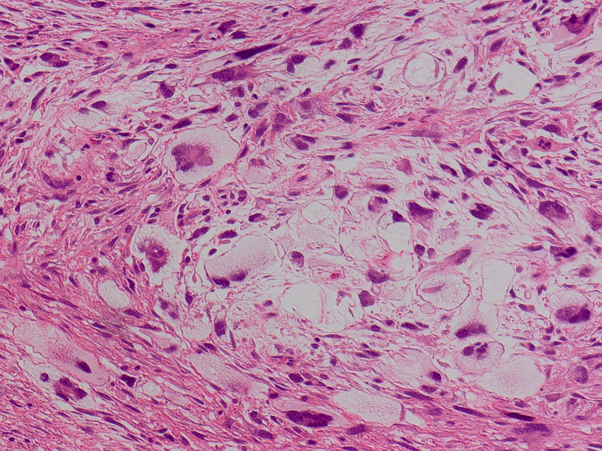 泡沫細胞 Foam cell JapaneseClass.jp