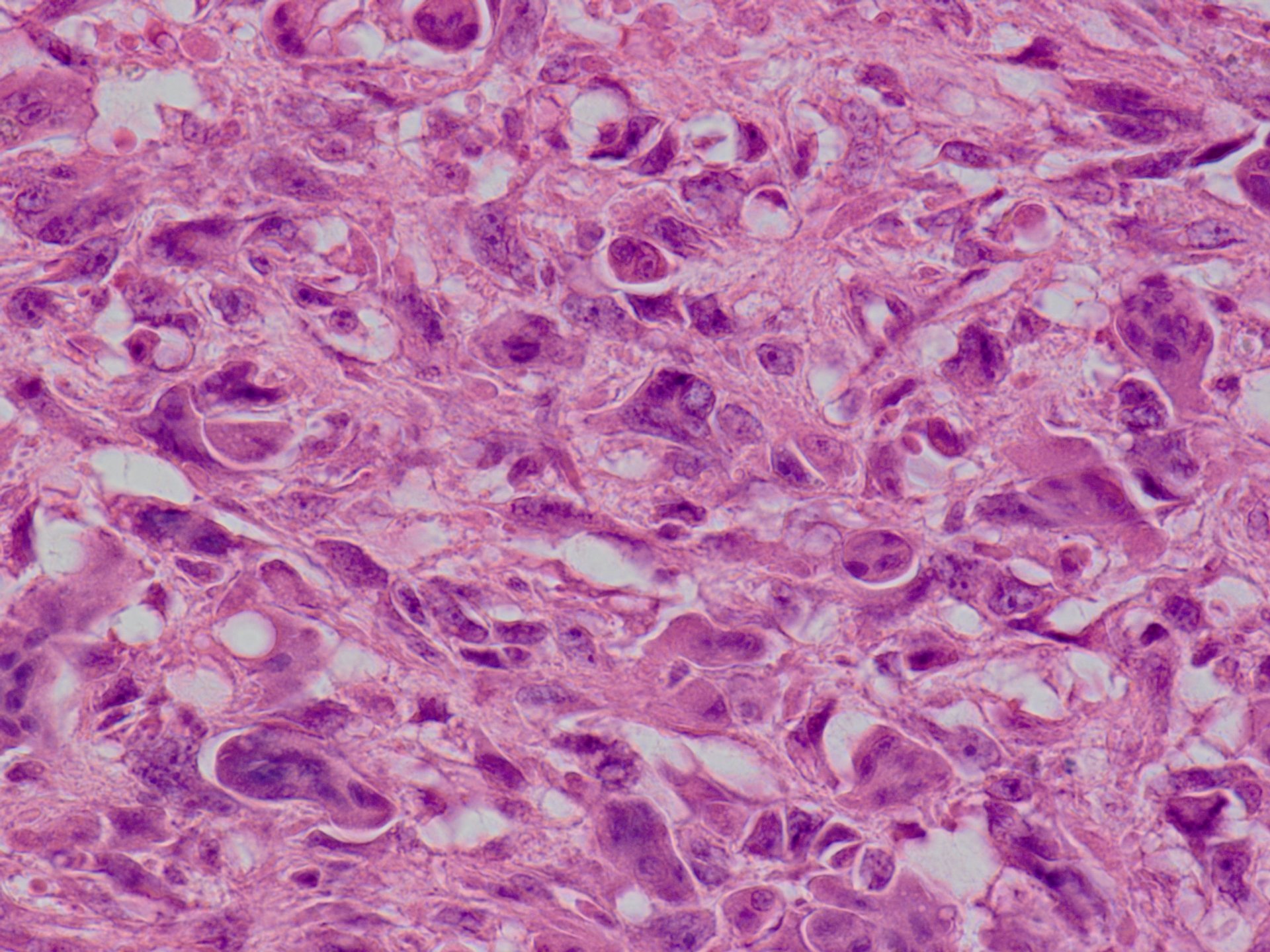 Telangiectatic Osteosarcoma 血管拡張型骨肉腫 軟部腫瘍病理の部屋