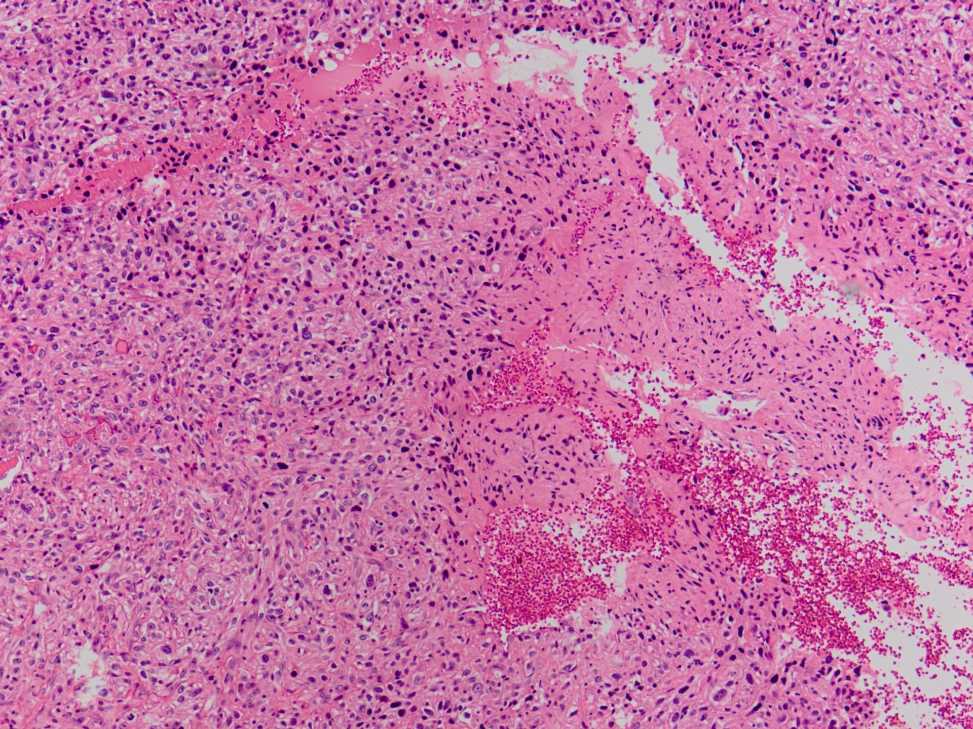 Osteoblastic Osteosarcoma 骨芽細胞型骨肉腫 軟部腫瘍病理の部屋