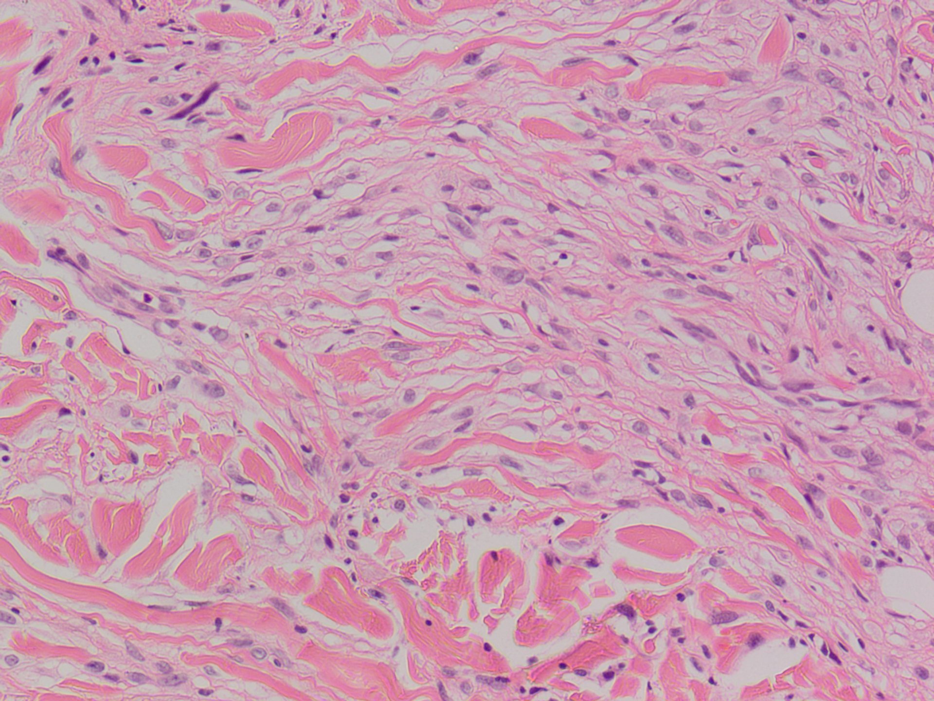 Atypical Fibrous Histiocytoma 異型線維性組織球腫 軟部腫瘍病理の部屋