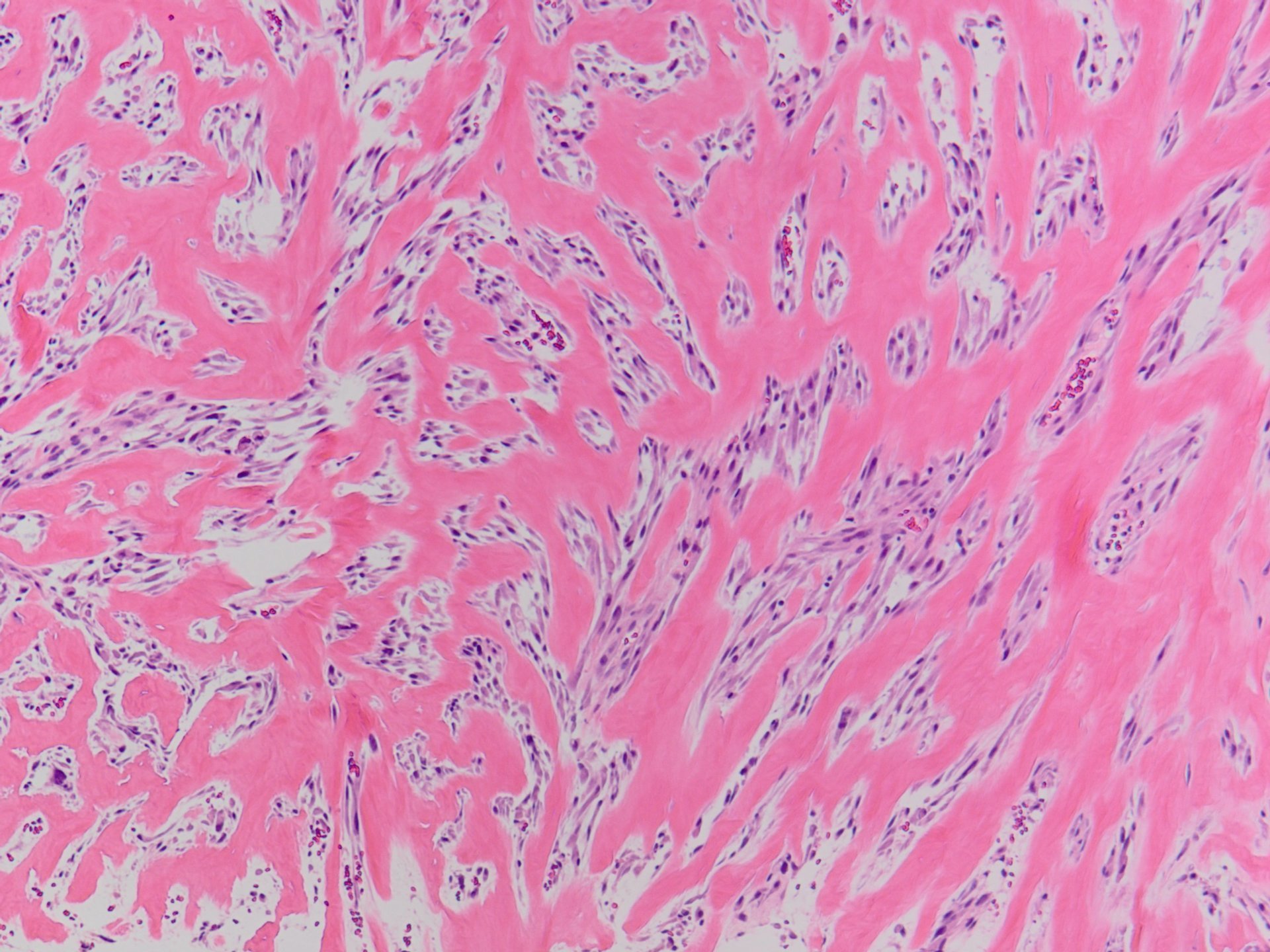 Sclerosing Rhabdomyosarcoma 硬化型横紋筋肉腫 軟部腫瘍病理の部屋