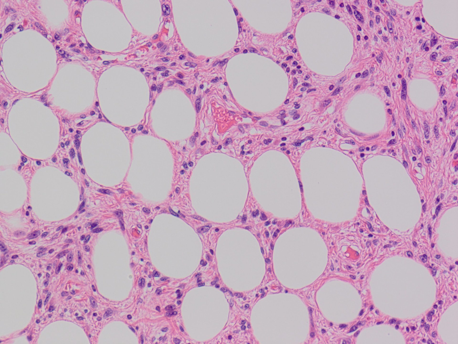 Low Grade Fibrosarcoma Not Otherwise Specified 非特定型低悪性度線維肉腫 軟部腫瘍病理の部屋