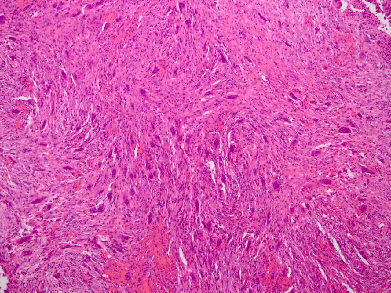 Nonossifying Fibroma Nof 非骨化性線維腫 軟部腫瘍病理の部屋