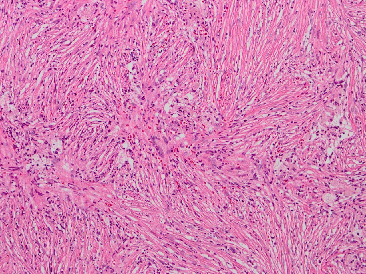 Benign Fibrous Histiocytoma Bfh Of Bone 骨の良性線維性組織球腫 軟部腫瘍病理の部屋