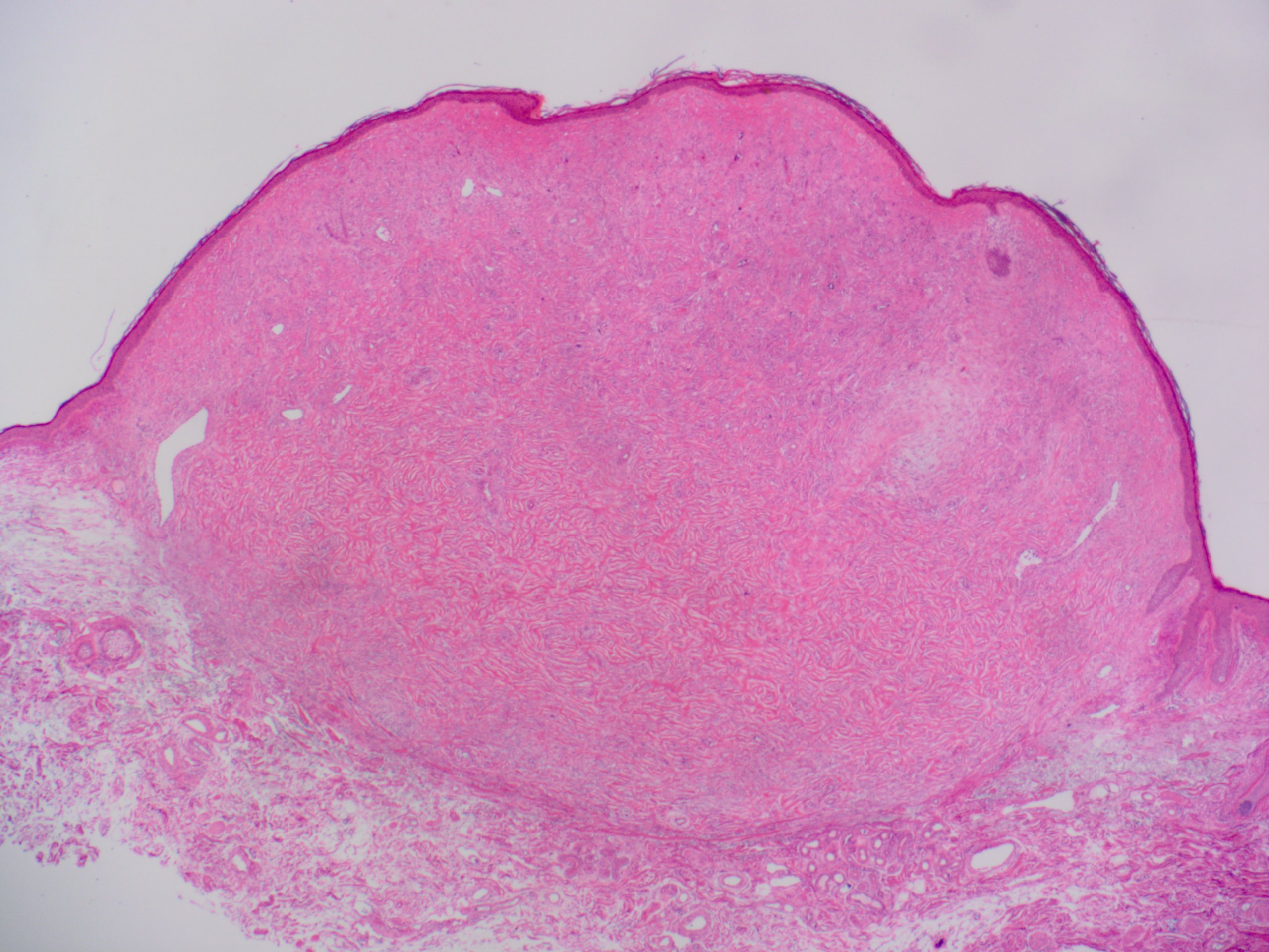 Storiform Collagenoma 花筵状膠原腫 軟部腫瘍病理の部屋