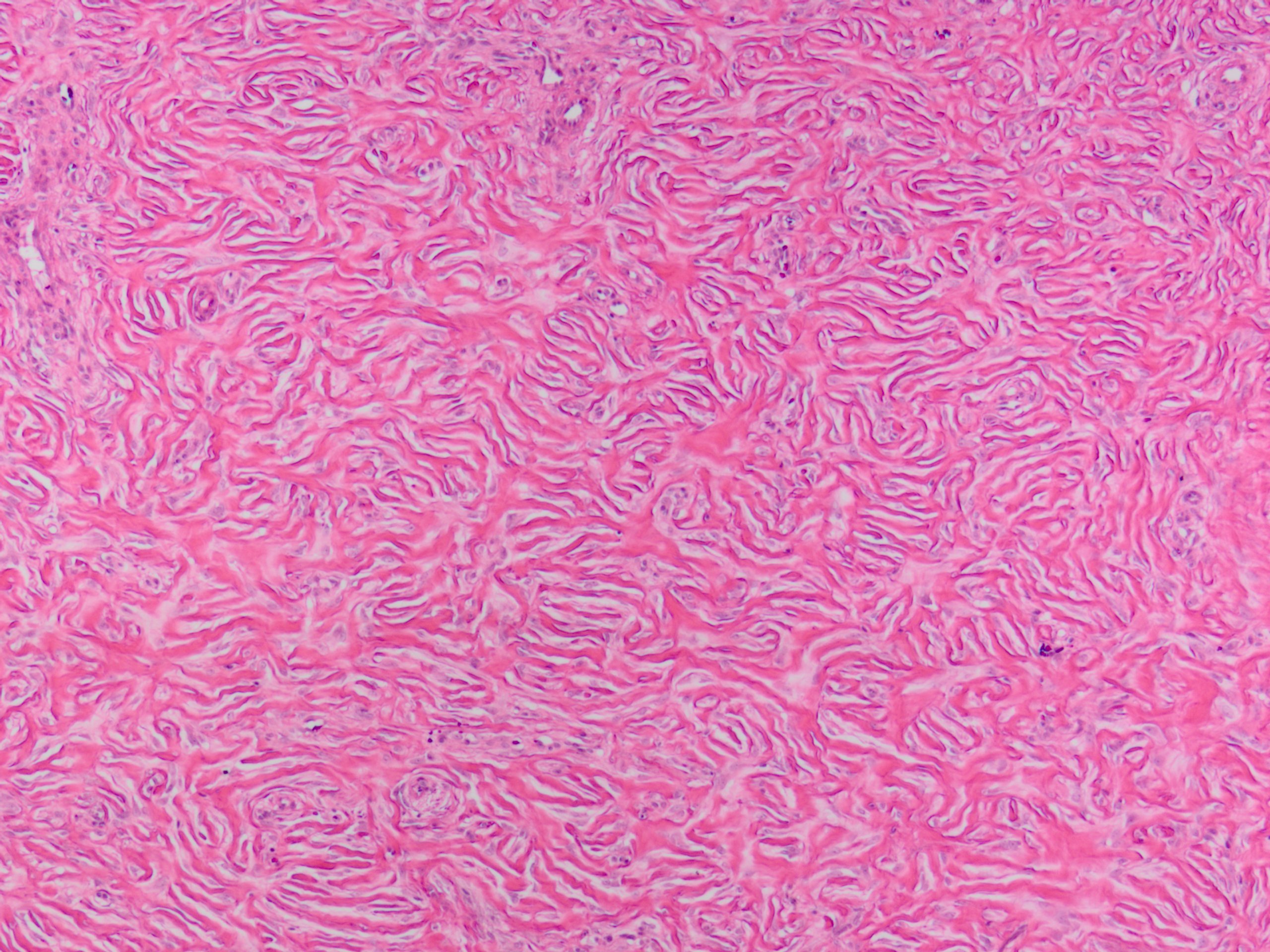 Storiform Collagenoma 花筵状膠原腫 軟部腫瘍病理の部屋