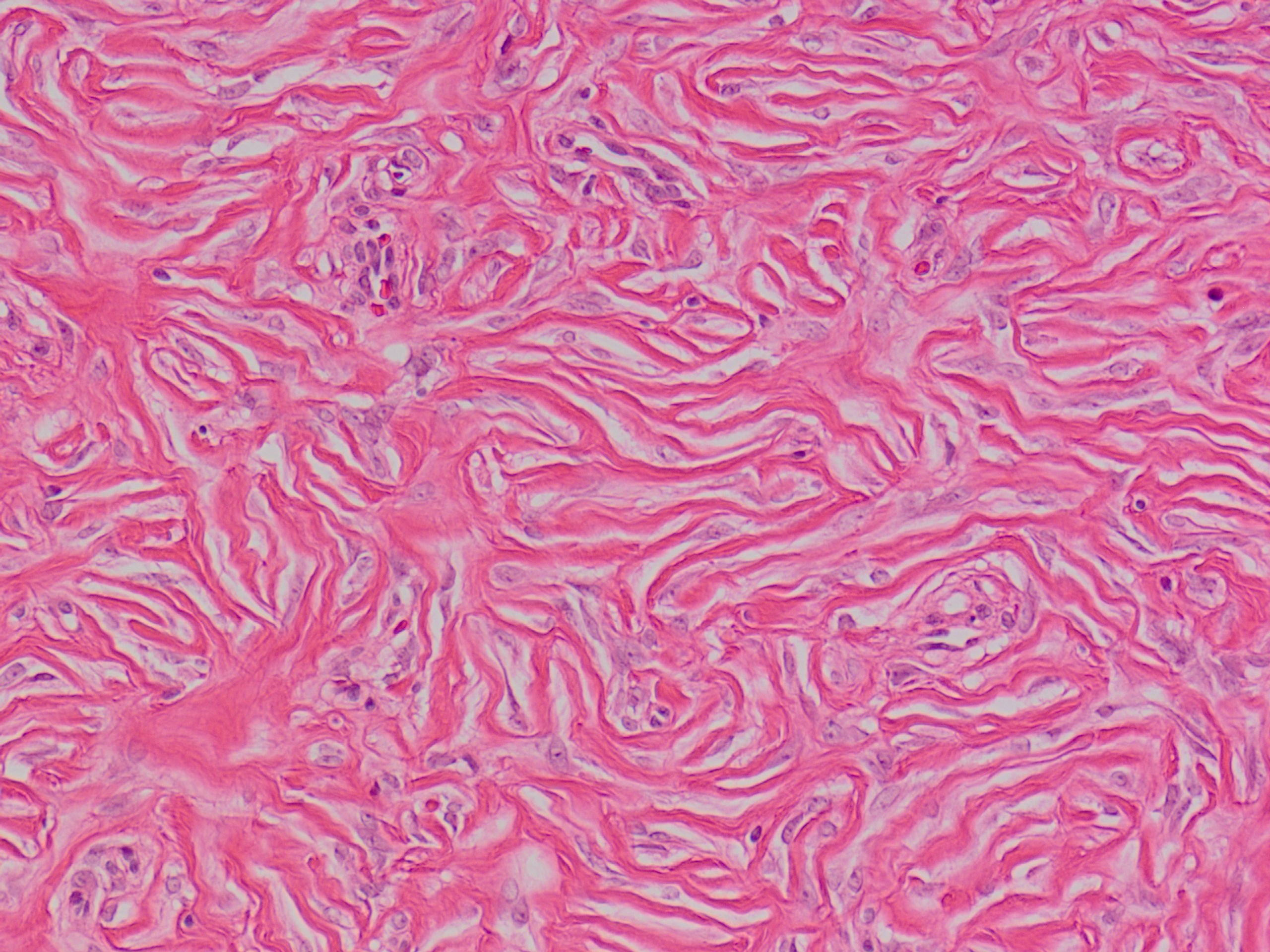 Storiform Collagenoma 花筵状膠原腫 軟部腫瘍病理の部屋