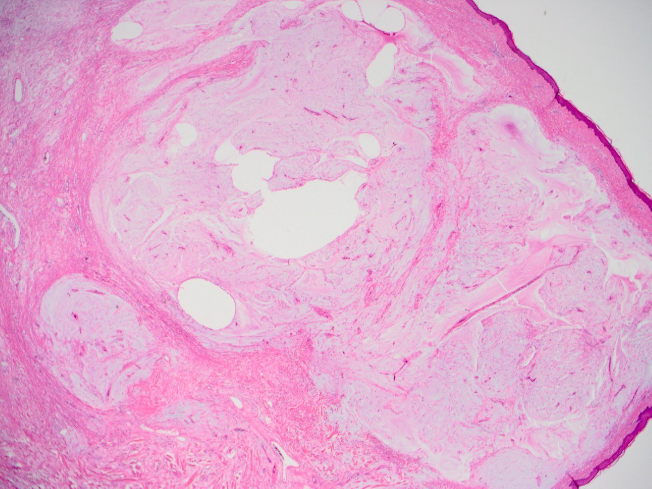 Superficial angiomyxoma 表在性血管粘液腫 軟部腫瘍病理の部屋