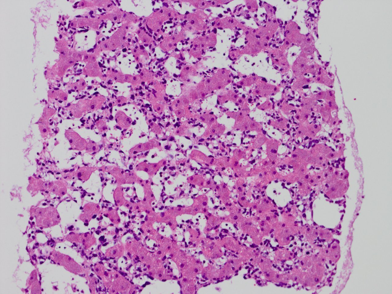 Hepatic Angiosarcoma 肝原発血管肉腫 軟部腫瘍病理の部屋