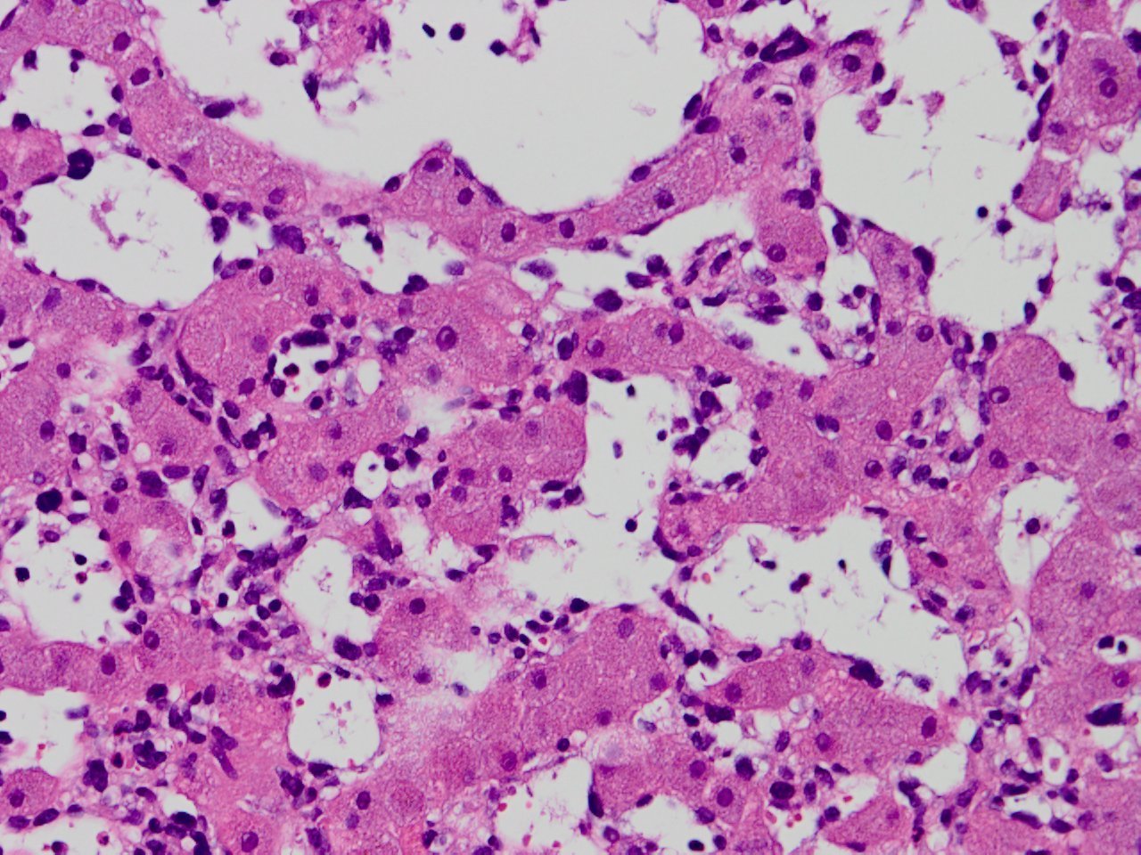 Hepatic Angiosarcoma 肝原発血管肉腫 軟部腫瘍病理の部屋