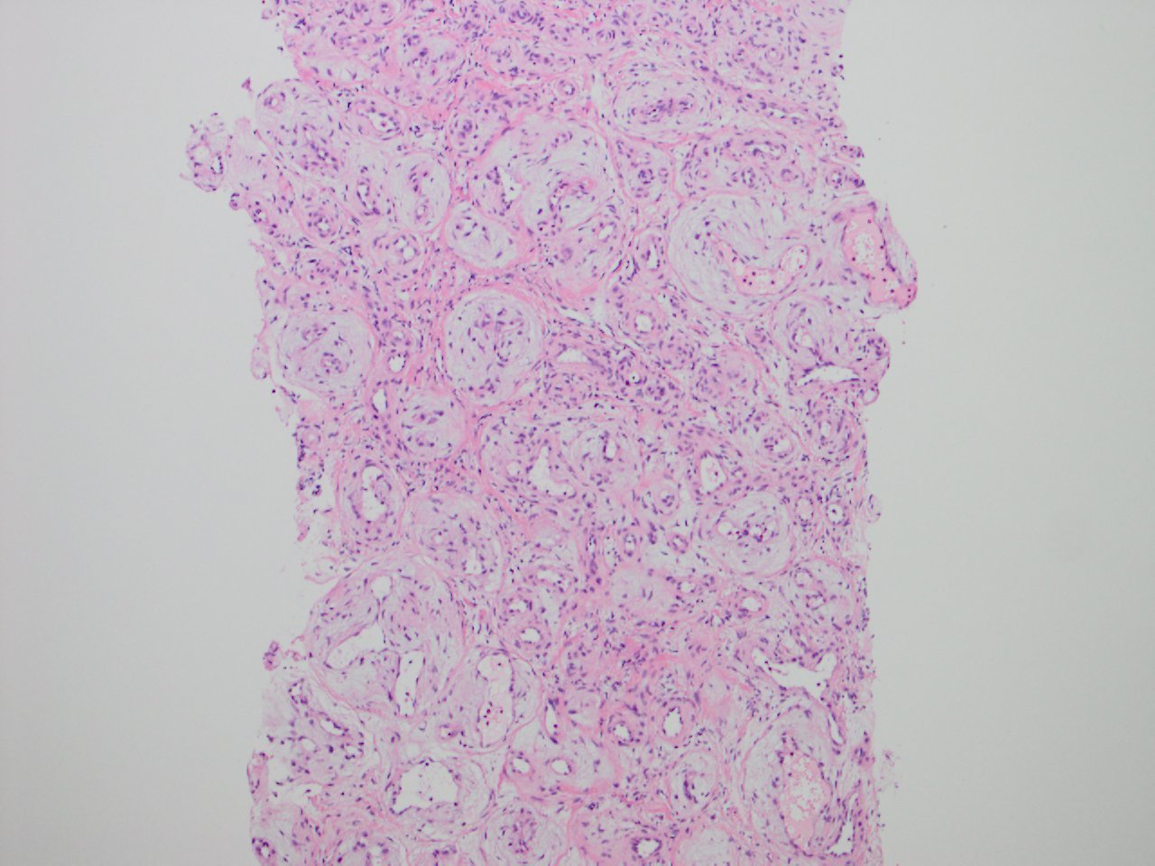 Sclerosing Hemangioma Of The Liver 肝の硬化性血管腫 軟部腫瘍病理の部屋