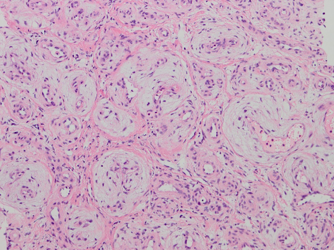 Sclerosing Hemangioma Of The Liver 肝の硬化性血管腫 軟部腫瘍病理の部屋