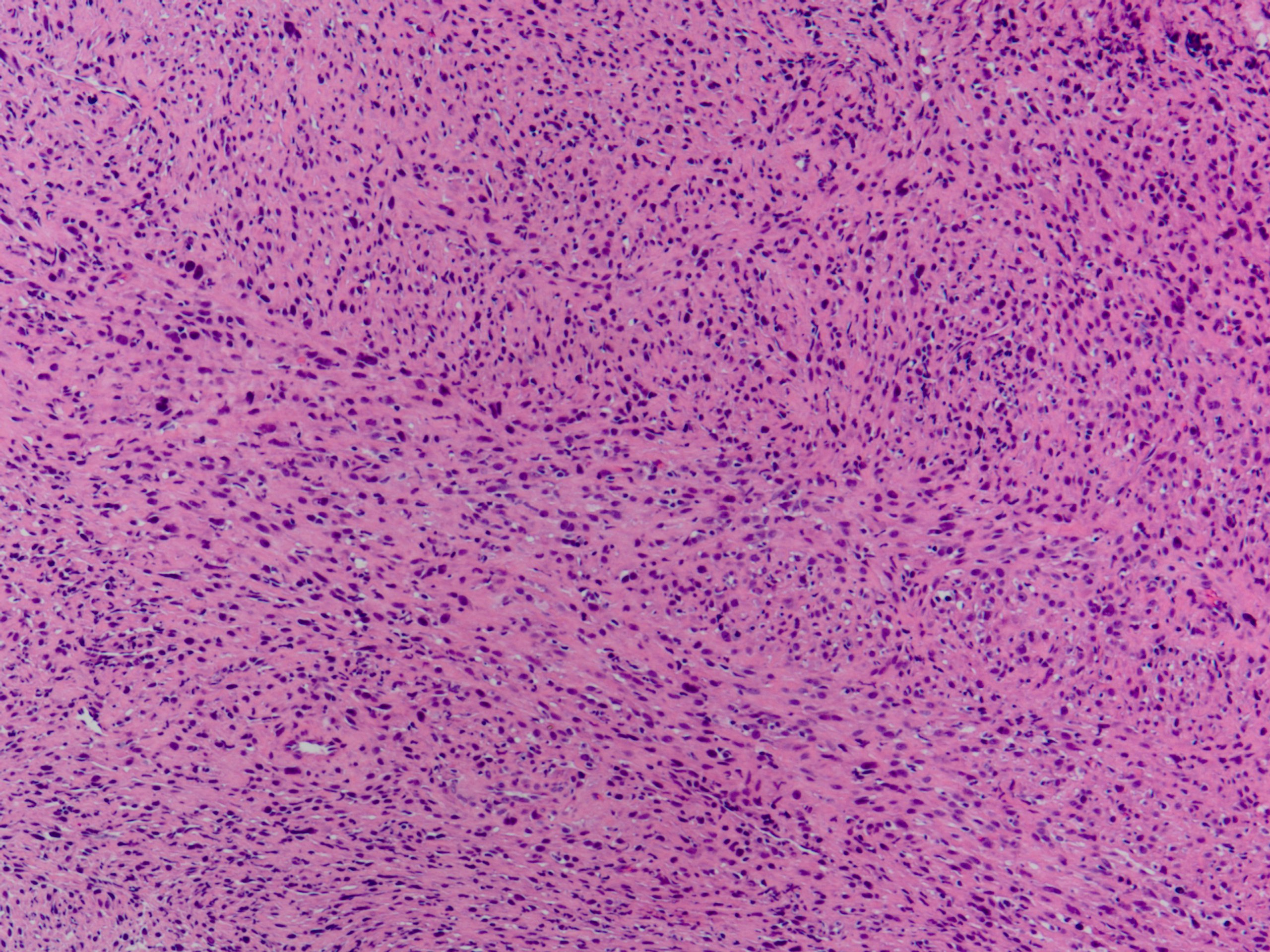 Myofibrosarcoma Of The Bone 骨の筋線維肉腫 軟部腫瘍病理の部屋