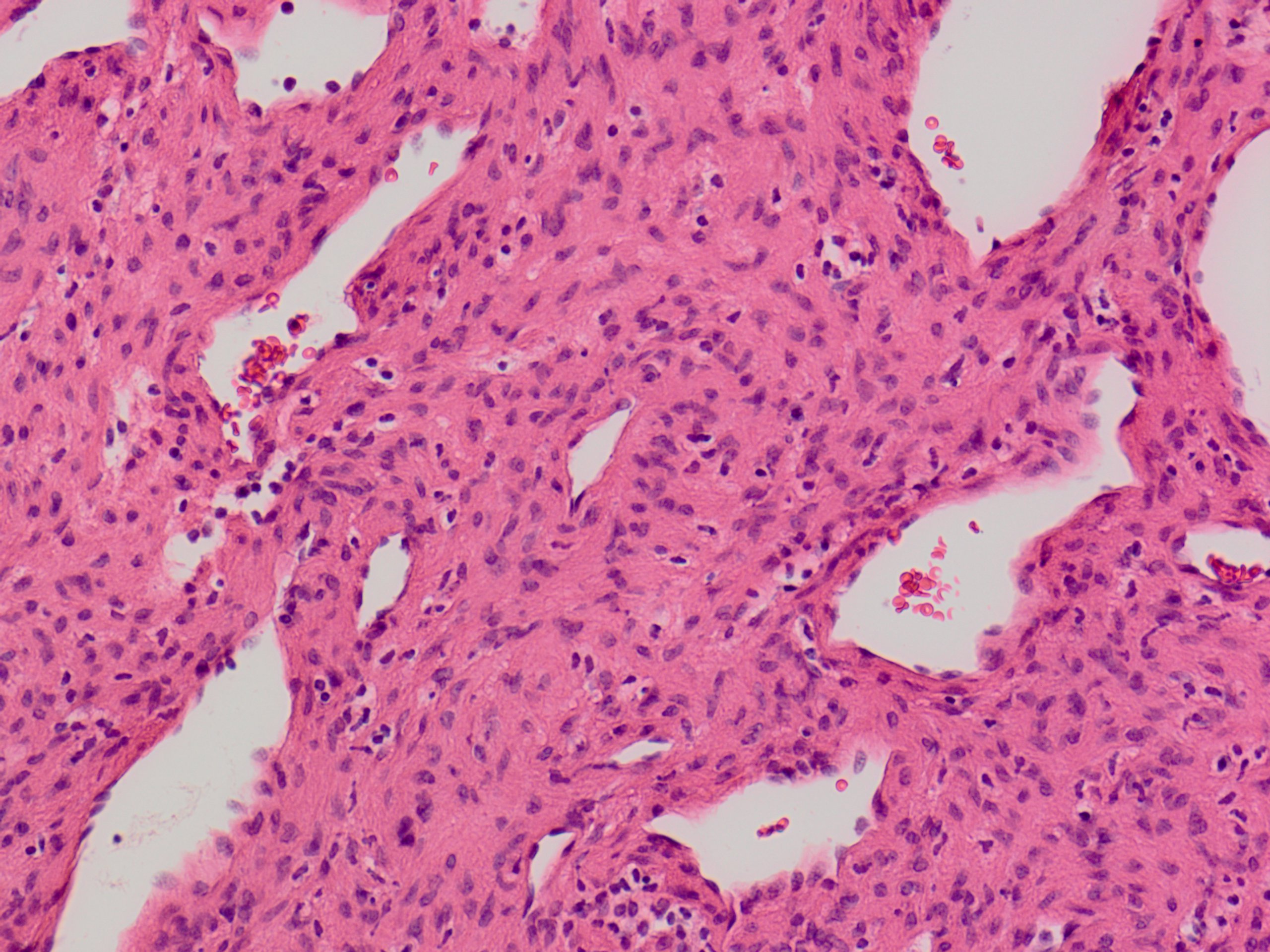 Myopericytoma 筋周皮腫: 軟部腫瘍病理の部屋