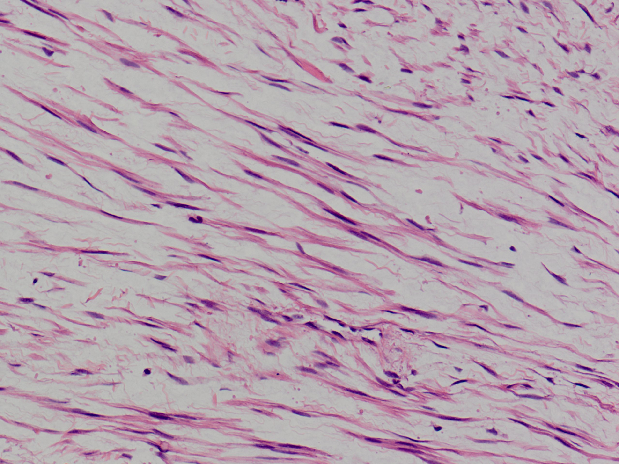 Pseudosarcomatous Myofibroblastic Proliferation Tumor Pmp T 偽肉腫様筋線維芽細胞性増殖 腫瘍 軟部腫瘍病理の部屋